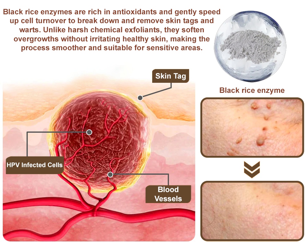 ✅Official Store: Zvoevo® Black Rice Skin Repair Essence Cream 👨⚕️ MHRA Certified (Eliminates warts and skin tags, relieves psoriasis, improves keratin build-up and follicular keratinization, fades pigmentation, age spots & sun spots)