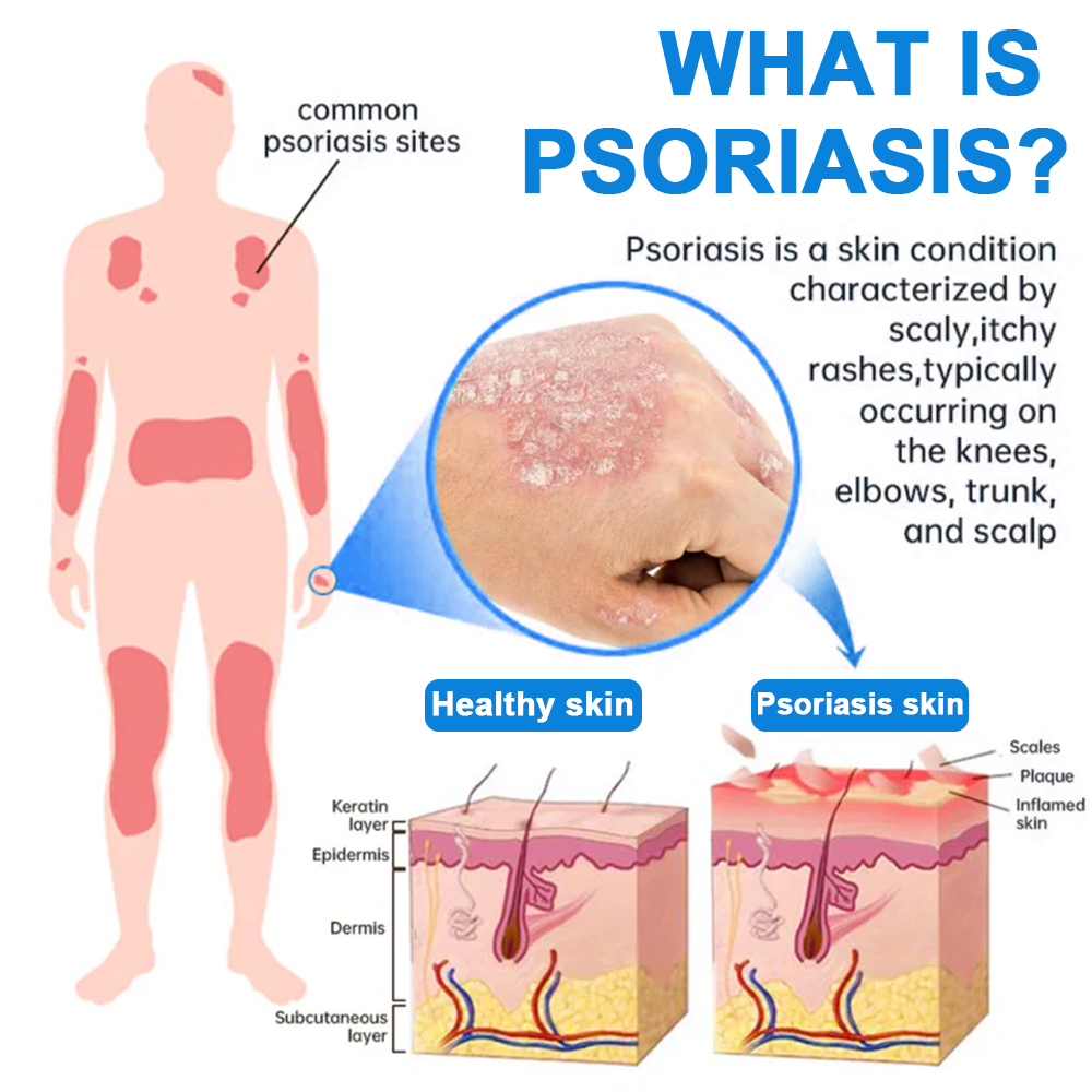 ✅ Official Store: Zvoevo® Magnesium Herbal Psoriasis Spray 👨‍⚕️ MHRA Approved (for the treatment of psoriasis and eczema, improvement of bacterial infections in the genital area, treatment of acne and warts)