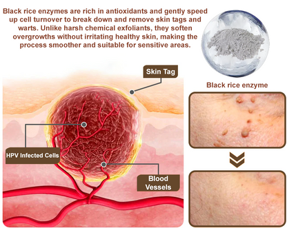 🌟Official Store: Zvoevo® Black Rice Skin Repair Essence Cream 👨‍⚕️ MHRA Certified (Eliminates warts and skin tags, relieves psoriasis, improves keratin build-up and follicular keratinization, fades pigmentation, age spots & sun spots)
