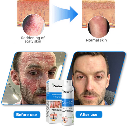 ✅ Official Store: Zvoevo® Magnesium Herbal Psoriasis Spray 👨‍⚕️ MHRA Approved (for the treatment of psoriasis and eczema, improvement of bacterial infections in the genital area, treatment of acne and warts)