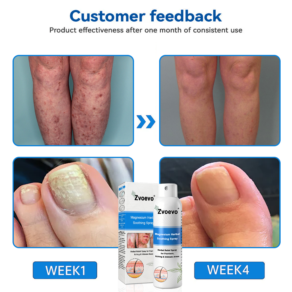 ✅ Official Store: Zvoevo® Magnesium Herbal Psoriasis Spray 👨‍⚕️ MHRA Approved (for the treatment of psoriasis and eczema, improvement of bacterial infections in the genital area, treatment of acne and warts)