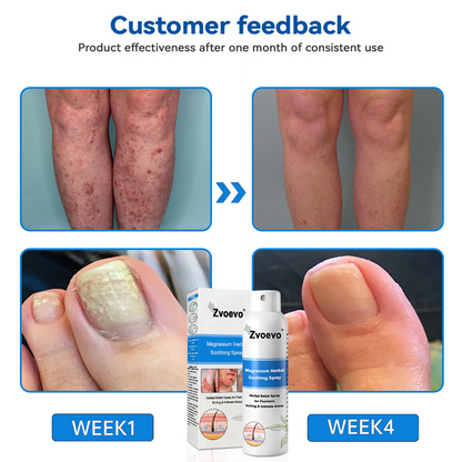 ✅ Official Store: Zvoevo® Magnesium Herbal Psoriasis Spray 👨‍⚕️ MHRA Approved (for the treatment of psoriasis and eczema, improvement of bacterial infections in the genital area, treatment of acne and warts)