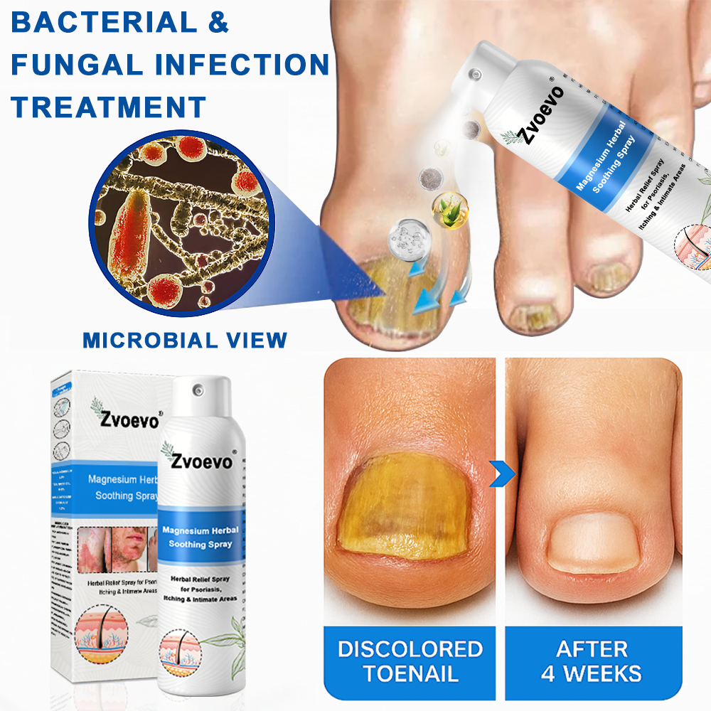 ✅ Official Store: Zvoevo® Magnesium Herbal Psoriasis Spray 👨‍⚕️ MHRA Approved (for the treatment of psoriasis and eczema, improvement of bacterial infections in the genital area, treatment of acne and warts)