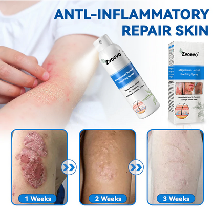 ✅ Official Store: Zvoevo® Magnesium Herbal Psoriasis Spray 👨‍⚕️ MHRA Approved (for the treatment of psoriasis and eczema, improvement of bacterial infections in the genital area, treatment of acne and warts)